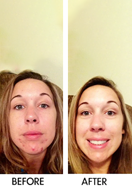 TEEK - SkinSanity® Dual Action Acne Serum – All-Natural 1 fl oz FACIAL SUPPLIES TEEK BCB